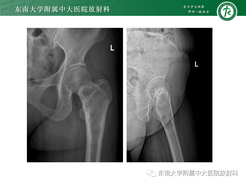 影像PPT - 【PPT】股骨肿瘤（样）病变影像诊断思路-2