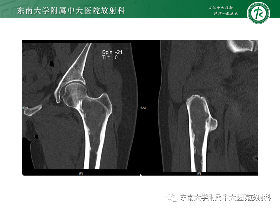 影像PPT - 【PPT】股骨肿瘤（样）病变影像诊断思路-3