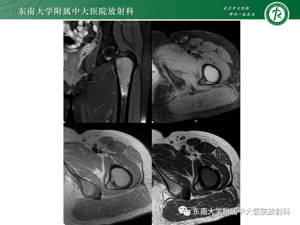 影像PPT - 【PPT】股骨肿瘤（样）病变影像诊断思路-4