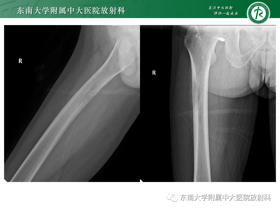 影像PPT - 【PPT】股骨肿瘤（样）病变影像诊断思路-6