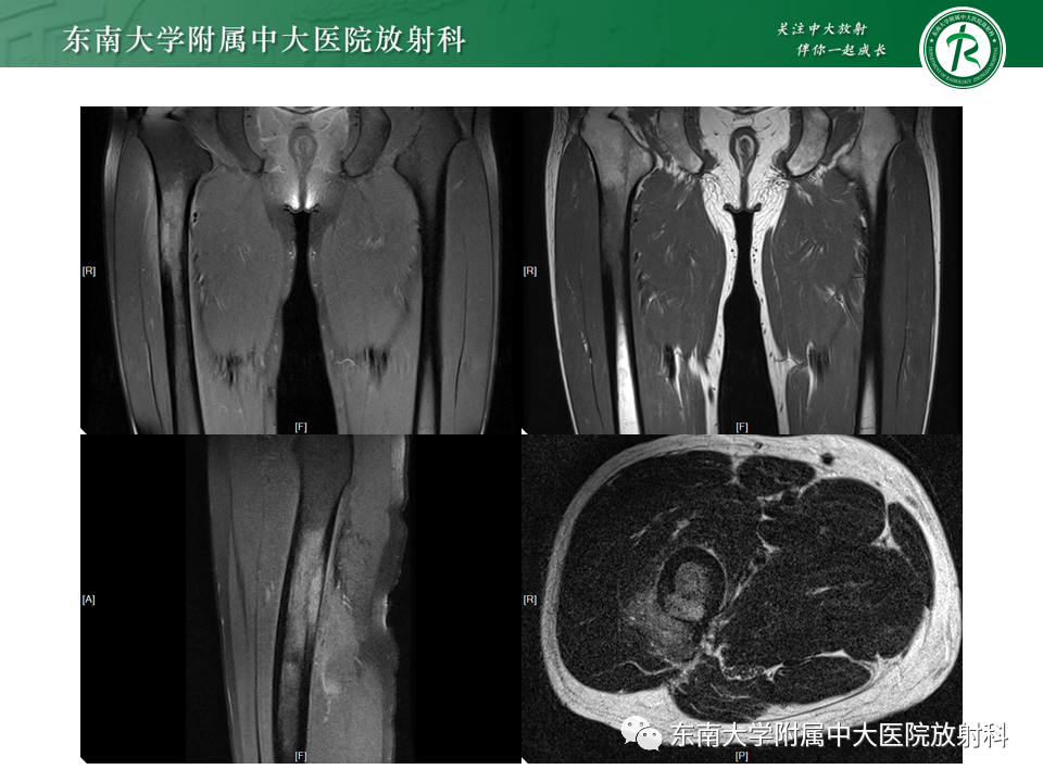 影像PPT - 【PPT】股骨肿瘤（样）病变影像诊断思路-7