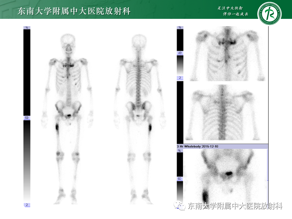 影像PPT - 【PPT】股骨肿瘤（样）病变影像诊断思路-8