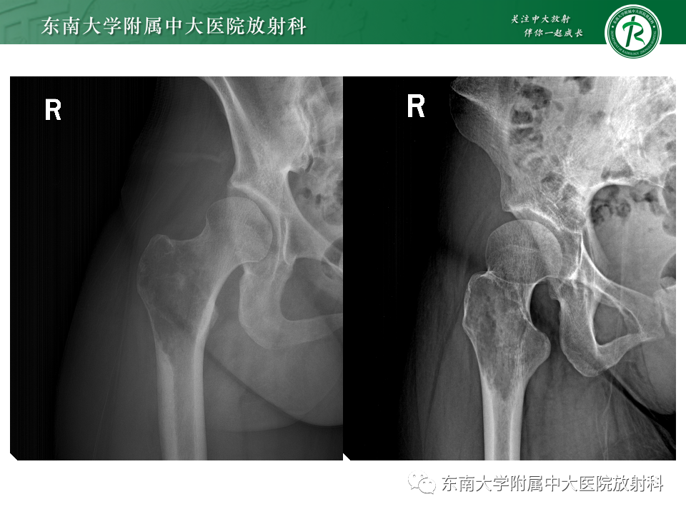 影像PPT - 【PPT】股骨肿瘤（样）病变影像诊断思路-10