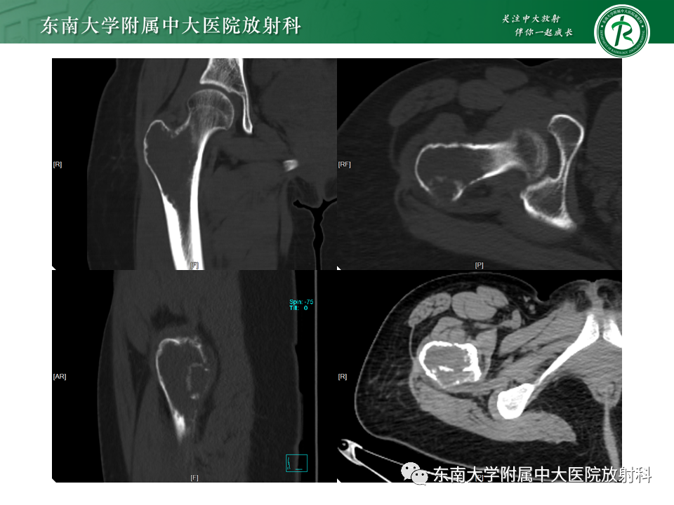 影像PPT - 【PPT】股骨肿瘤（样）病变影像诊断思路-11