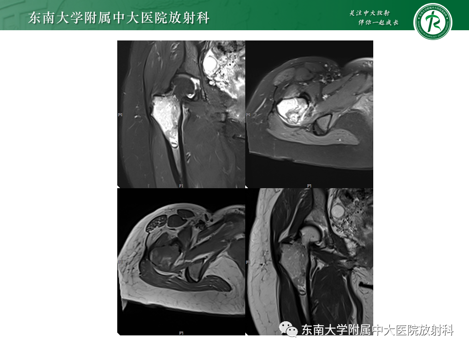 影像PPT - 【PPT】股骨肿瘤（样）病变影像诊断思路-12