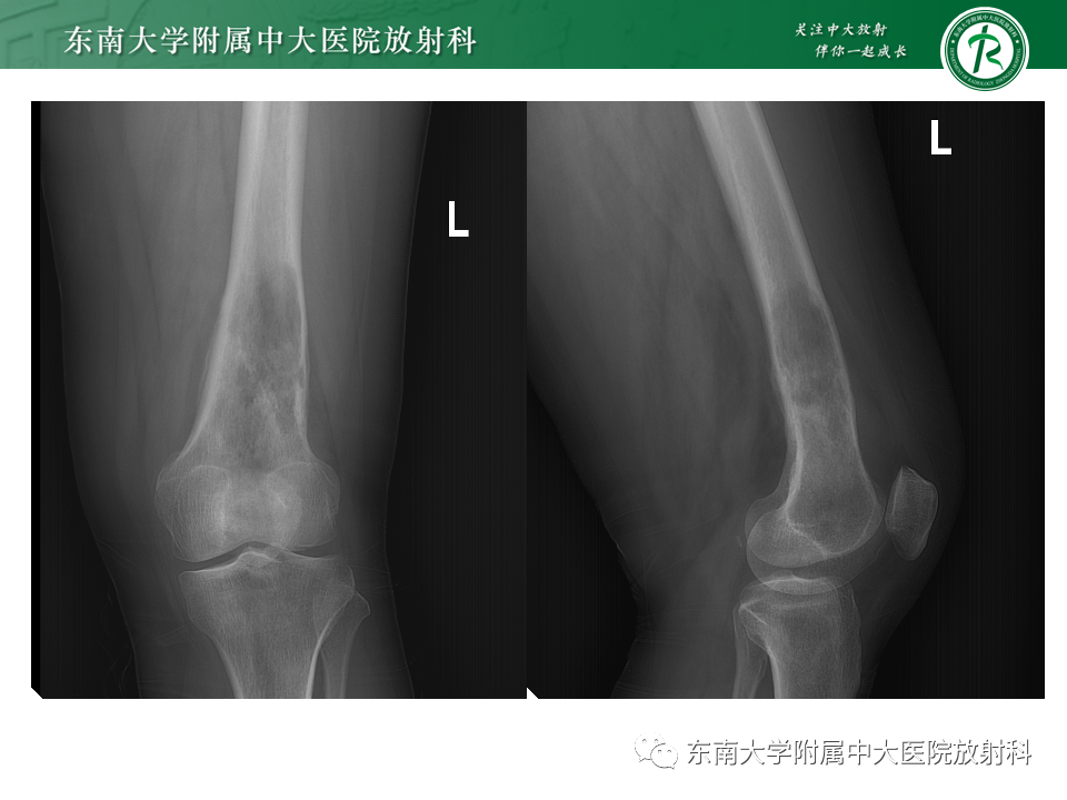 影像PPT - 【PPT】股骨肿瘤（样）病变影像诊断思路-14