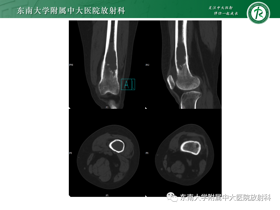 影像PPT - 【PPT】股骨肿瘤（样）病变影像诊断思路-15