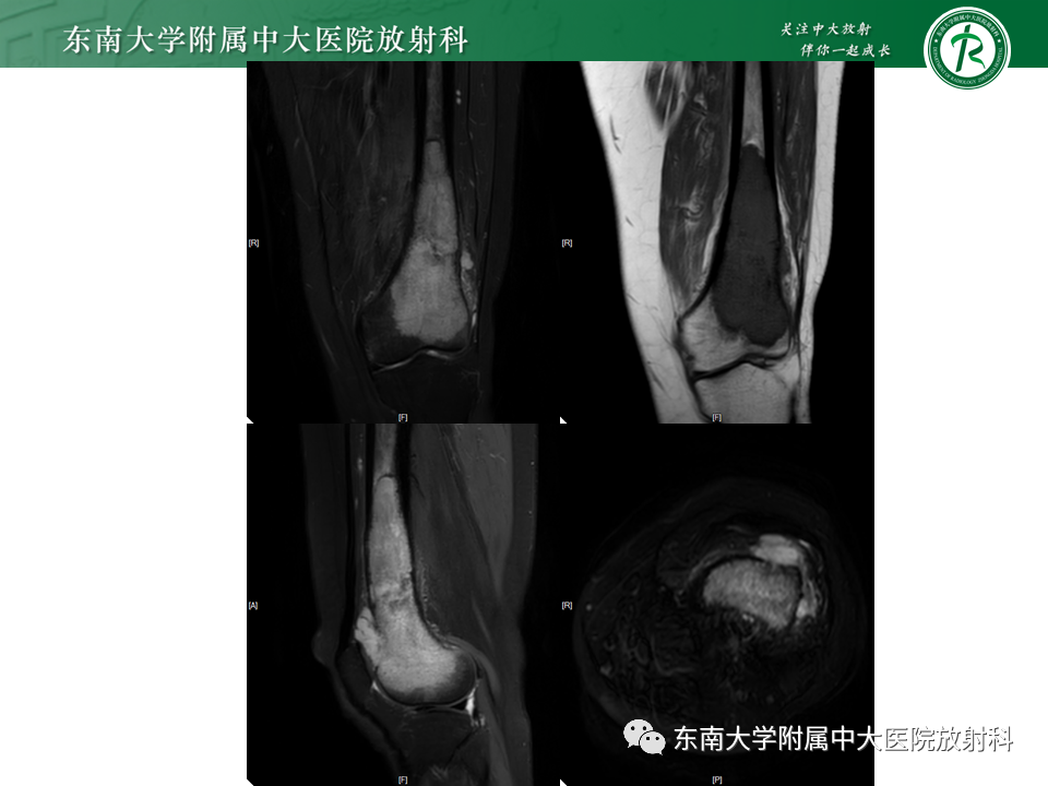 影像PPT - 【PPT】股骨肿瘤（样）病变影像诊断思路-16