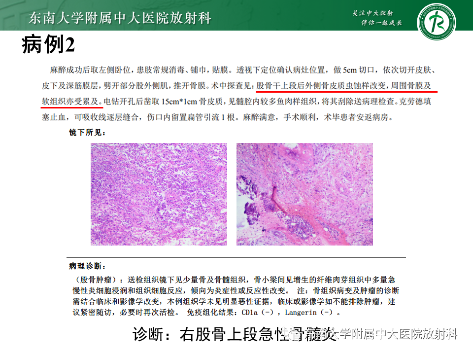 影像PPT - 【PPT】股骨肿瘤（样）病变影像诊断思路-18
