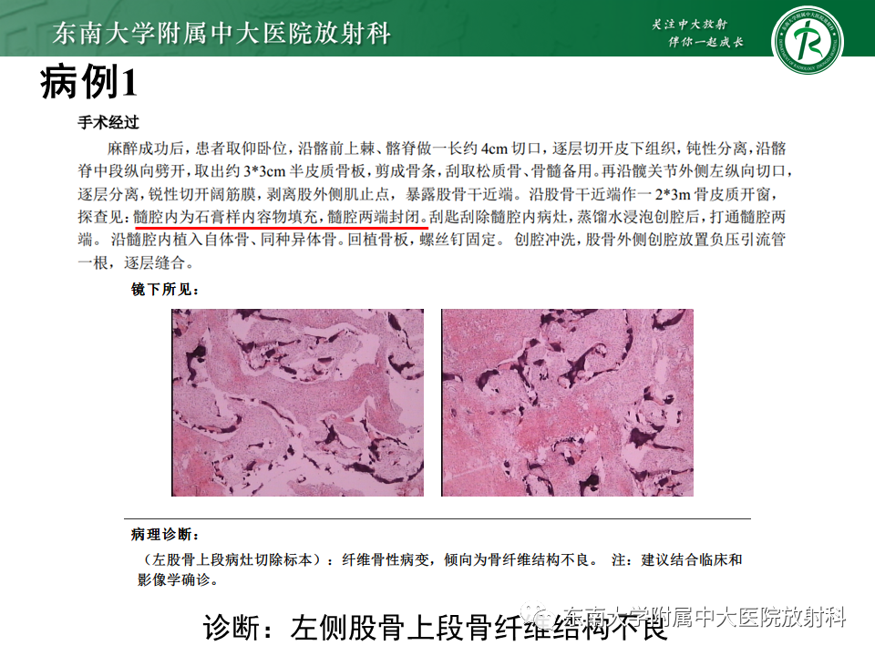 影像PPT - 【PPT】股骨肿瘤（样）病变影像诊断思路-17