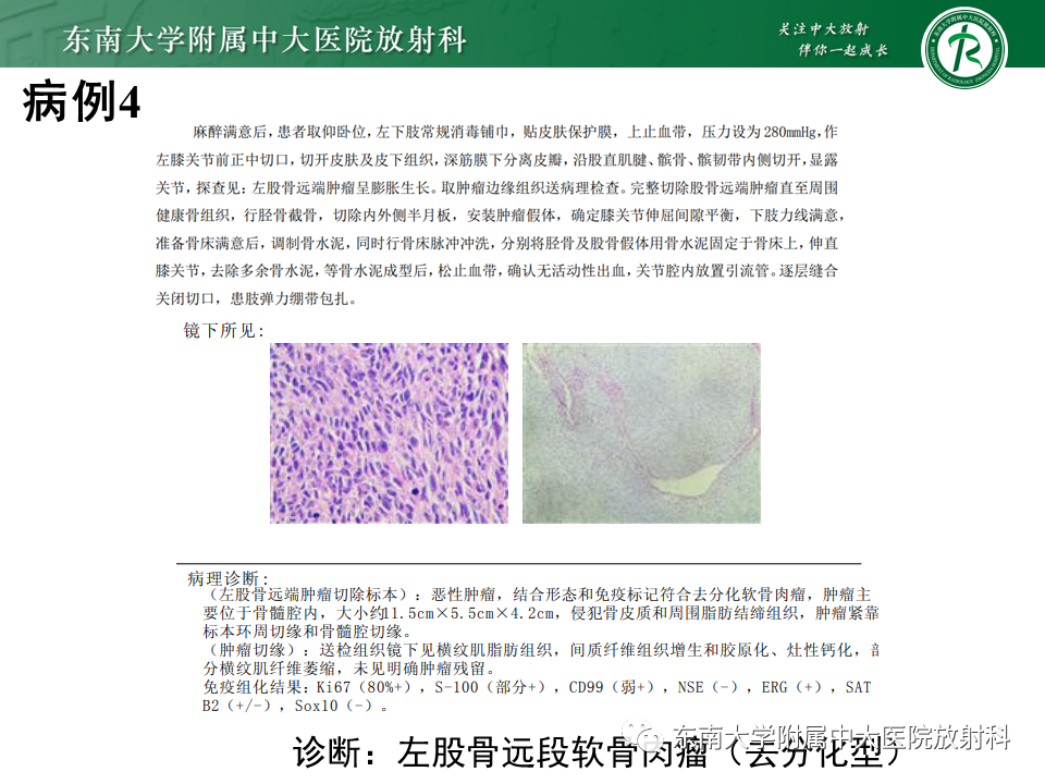 影像PPT - 【PPT】股骨肿瘤（样）病变影像诊断思路-20