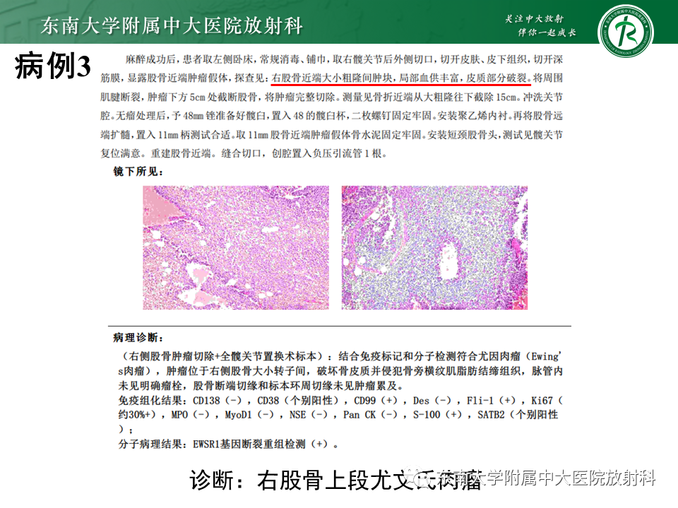 影像PPT - 【PPT】股骨肿瘤（样）病变影像诊断思路-19