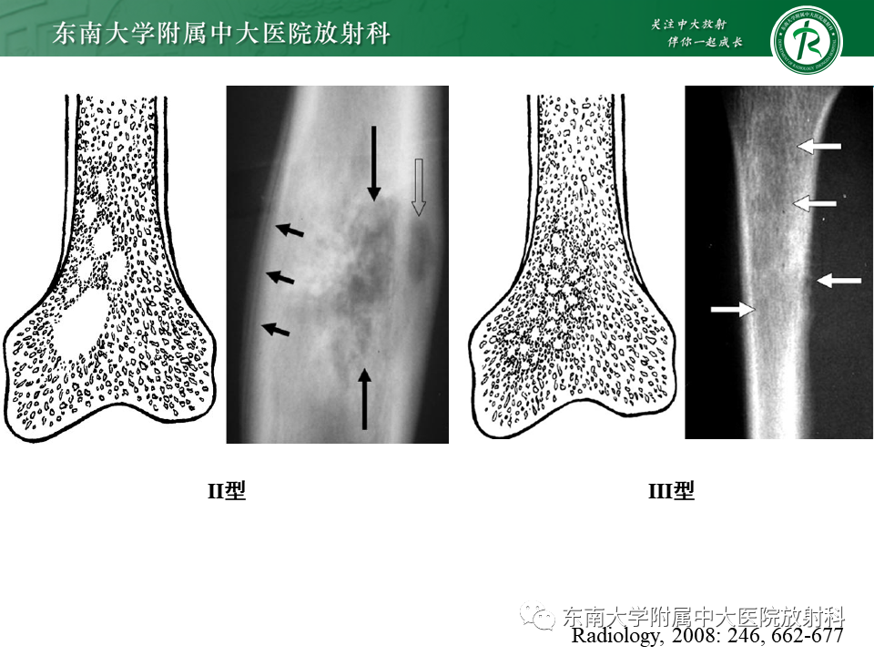 影像PPT - 【PPT】股骨肿瘤（样）病变影像诊断思路-26