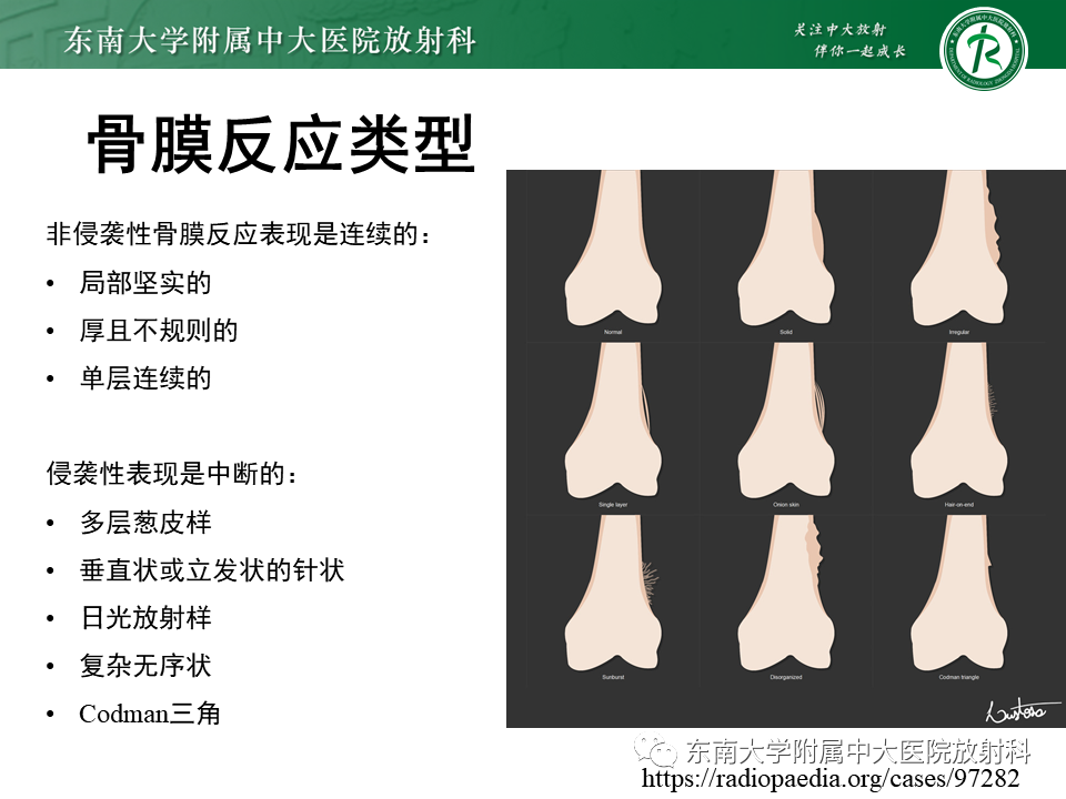 影像PPT - 【PPT】股骨肿瘤（样）病变影像诊断思路-27