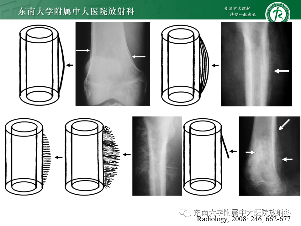 影像PPT - 【PPT】股骨肿瘤（样）病变影像诊断思路-28