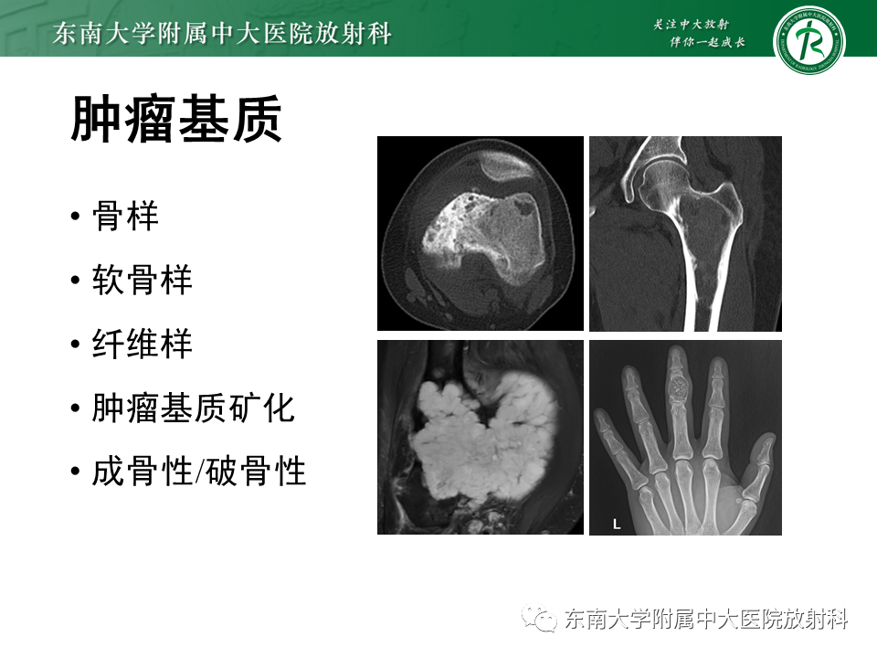 影像PPT - 【PPT】股骨肿瘤（样）病变影像诊断思路-29