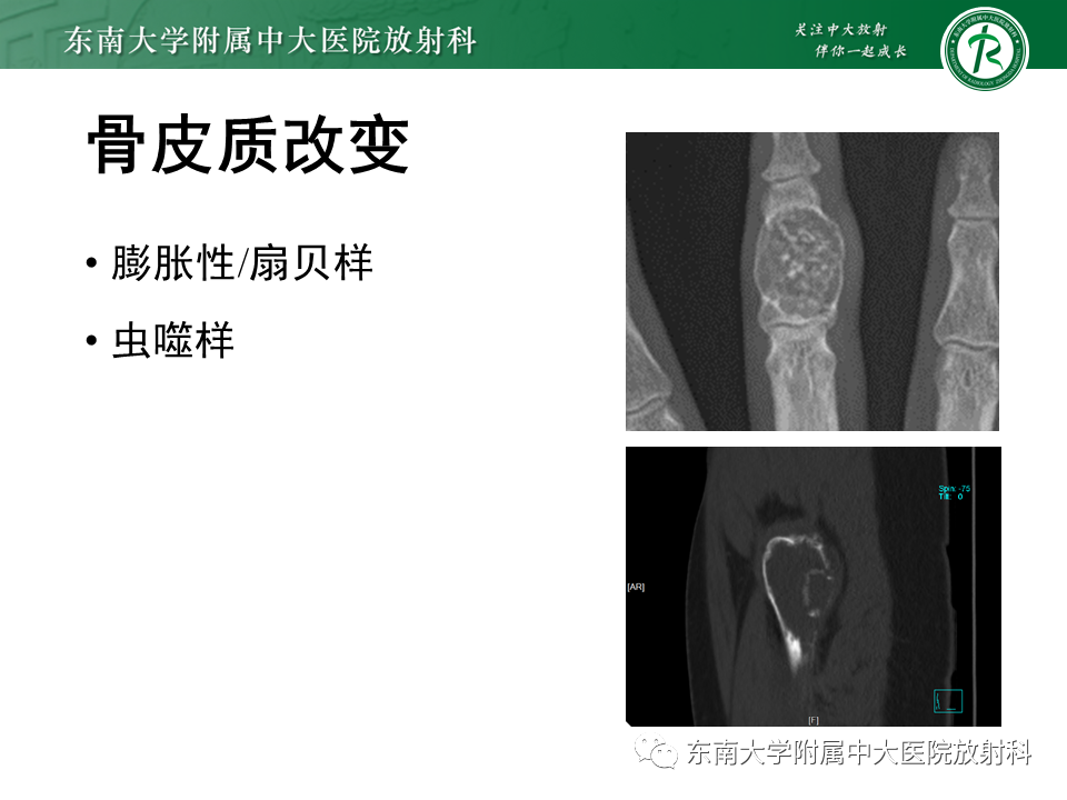 影像PPT - 【PPT】股骨肿瘤（样）病变影像诊断思路-30