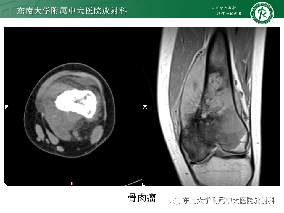影像PPT - 【PPT】股骨肿瘤（样）病变影像诊断思路-32