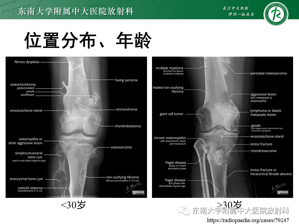 影像PPT - 【PPT】股骨肿瘤（样）病变影像诊断思路-33