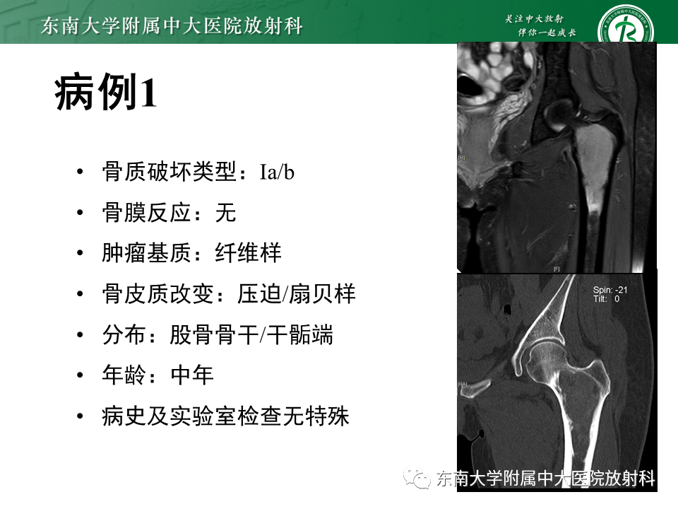 影像PPT - 【PPT】股骨肿瘤（样）病变影像诊断思路-35
