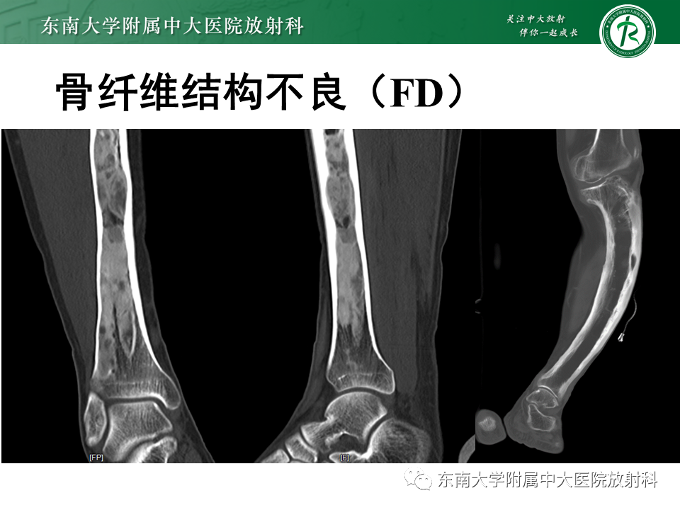 影像PPT - 【PPT】股骨肿瘤（样）病变影像诊断思路-37