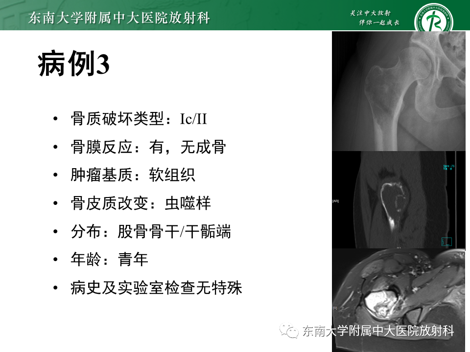 影像PPT - 【PPT】股骨肿瘤（样）病变影像诊断思路-38