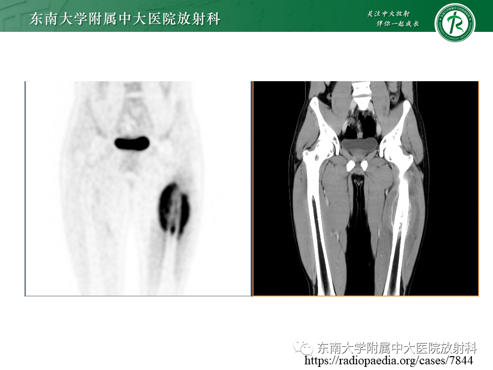 影像PPT - 【PPT】股骨肿瘤（样）病变影像诊断思路-41