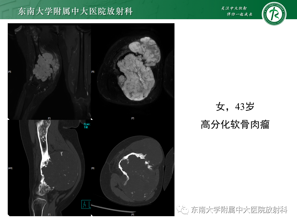 影像PPT - 【PPT】股骨肿瘤（样）病变影像诊断思路-46