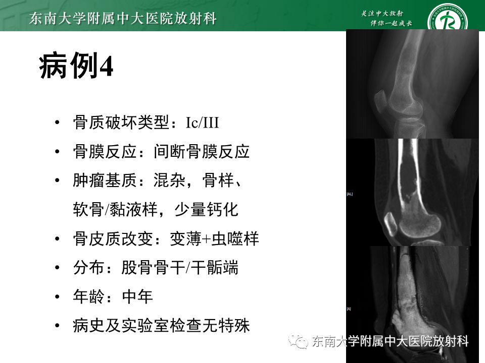 影像PPT - 【PPT】股骨肿瘤（样）病变影像诊断思路-47