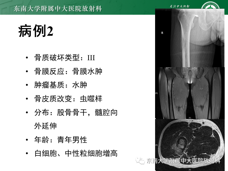 影像PPT - 【PPT】股骨肿瘤（样）病变影像诊断思路-48