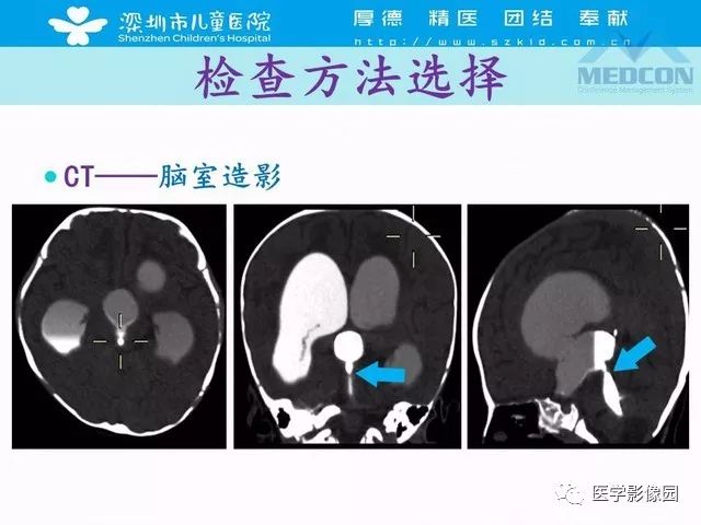 影像PPT - 【PPT】脑积水定义、分类新进展和影像诊断-17
