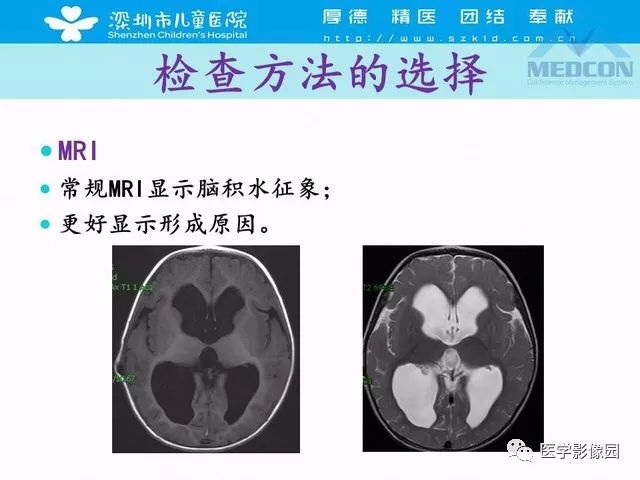 影像PPT - 【PPT】脑积水定义、分类新进展和影像诊断-18