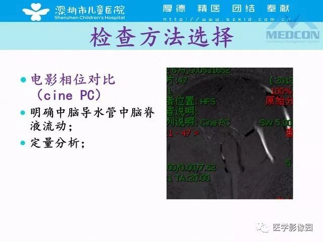 影像PPT - 【PPT】脑积水定义、分类新进展和影像诊断-23