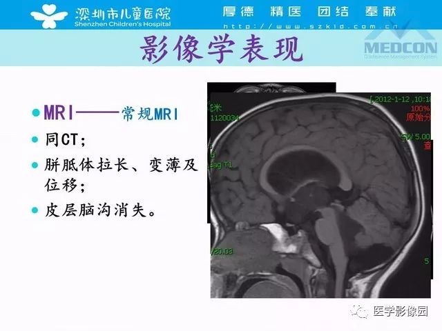 影像PPT - 【PPT】脑积水定义、分类新进展和影像诊断-25