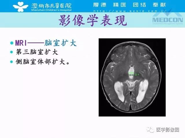 影像PPT - 【PPT】脑积水定义、分类新进展和影像诊断-26