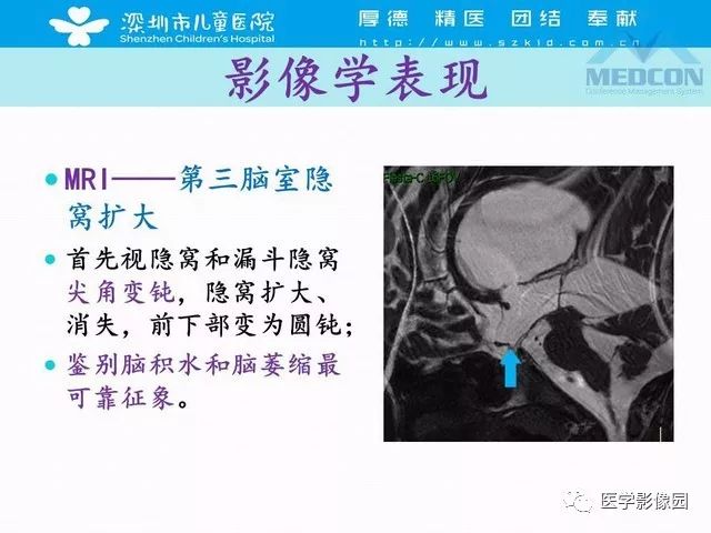 影像PPT - 【PPT】脑积水定义、分类新进展和影像诊断-27