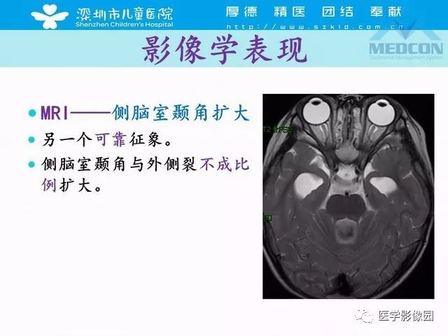 影像PPT - 【PPT】脑积水定义、分类新进展和影像诊断-28