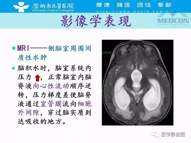 影像PPT - 【PPT】脑积水定义、分类新进展和影像诊断-29