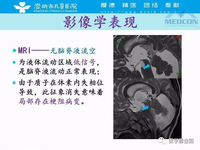 影像PPT - 【PPT】脑积水定义、分类新进展和影像诊断-30