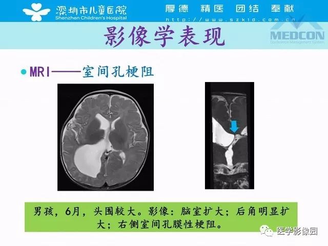 影像PPT - 【PPT】脑积水定义、分类新进展和影像诊断-32