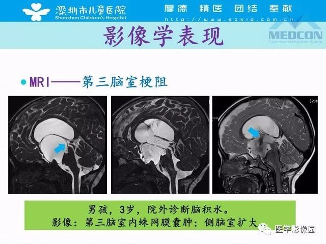 影像PPT - 【PPT】脑积水定义、分类新进展和影像诊断-34