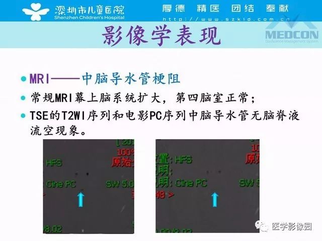 影像PPT - 【PPT】脑积水定义、分类新进展和影像诊断-35