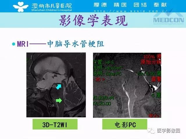 影像PPT - 【PPT】脑积水定义、分类新进展和影像诊断-36