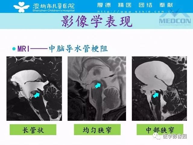 影像PPT - 【PPT】脑积水定义、分类新进展和影像诊断-37