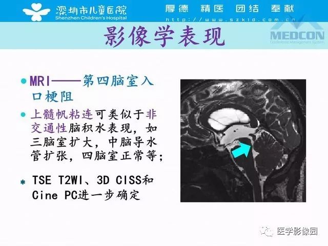 影像PPT - 【PPT】脑积水定义、分类新进展和影像诊断-39