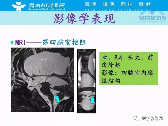 影像PPT - 【PPT】脑积水定义、分类新进展和影像诊断-40