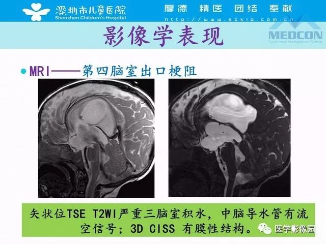 影像PPT - 【PPT】脑积水定义、分类新进展和影像诊断-42
