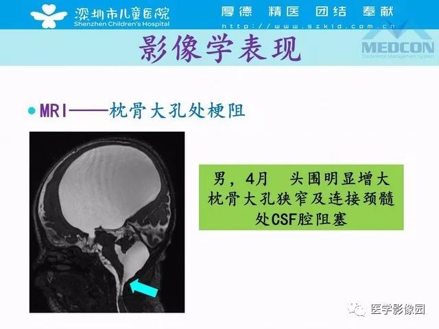 影像PPT - 【PPT】脑积水定义、分类新进展和影像诊断-44