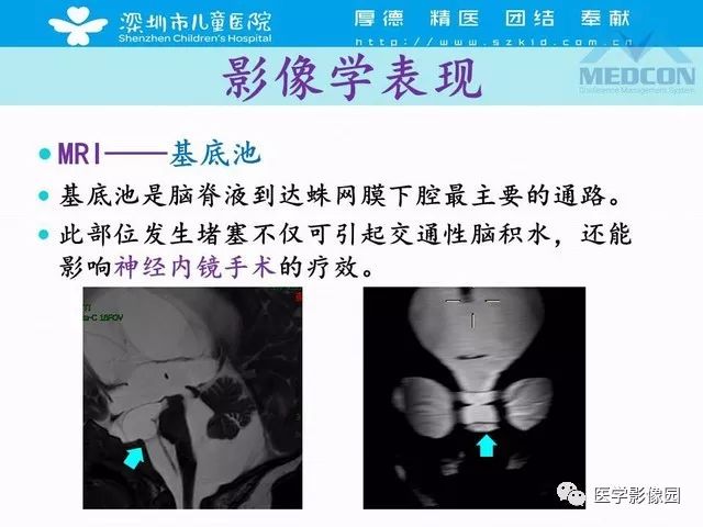 影像PPT - 【PPT】脑积水定义、分类新进展和影像诊断-45
