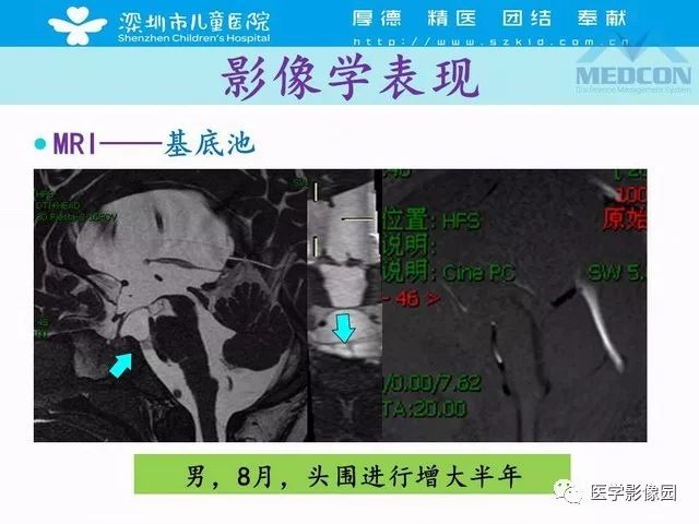 影像PPT - 【PPT】脑积水定义、分类新进展和影像诊断-46